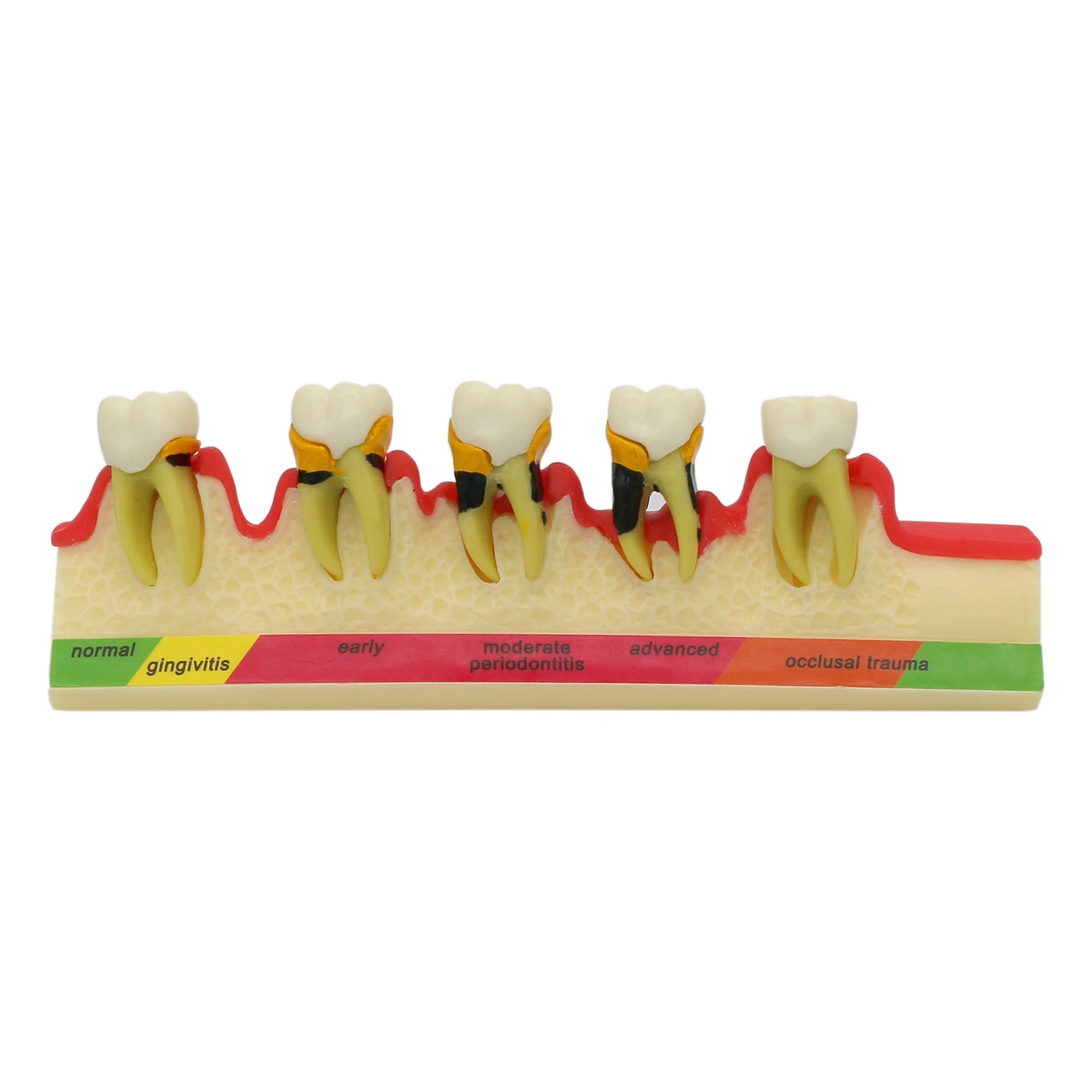 

Dentistry Periodontal Disease Teeth Model Caries Breakdown Periodontitis Pathological 5 Stages Progress For Dental Teaching