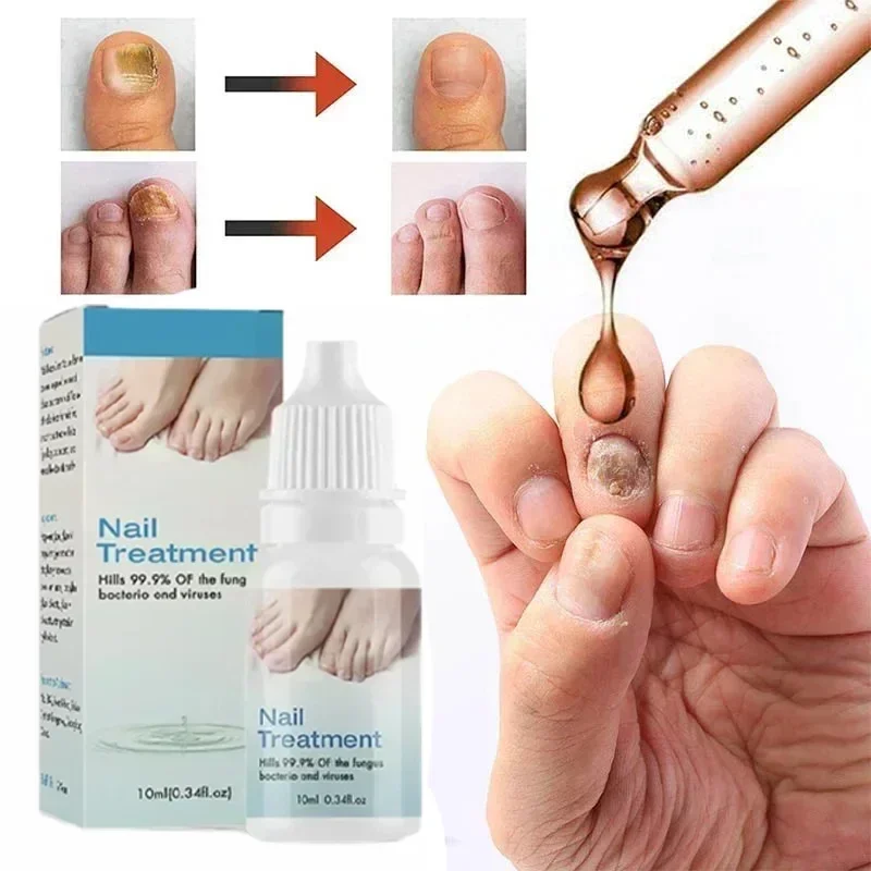 

Effective treatment of onychomycosis, removal of paronychia, anti oil fungus nail infection, care of toenail polish