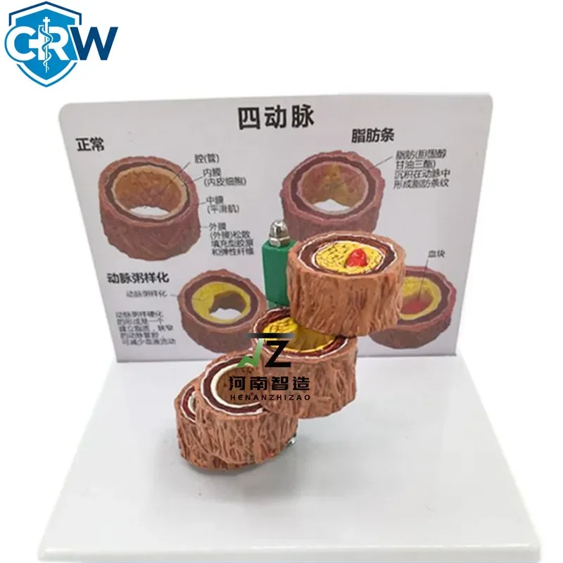 CRW Bestselling Four-stage Anatomical Vascular Thrombosis Model for Human Branch Artery Atherosclerosis Disease Study Model