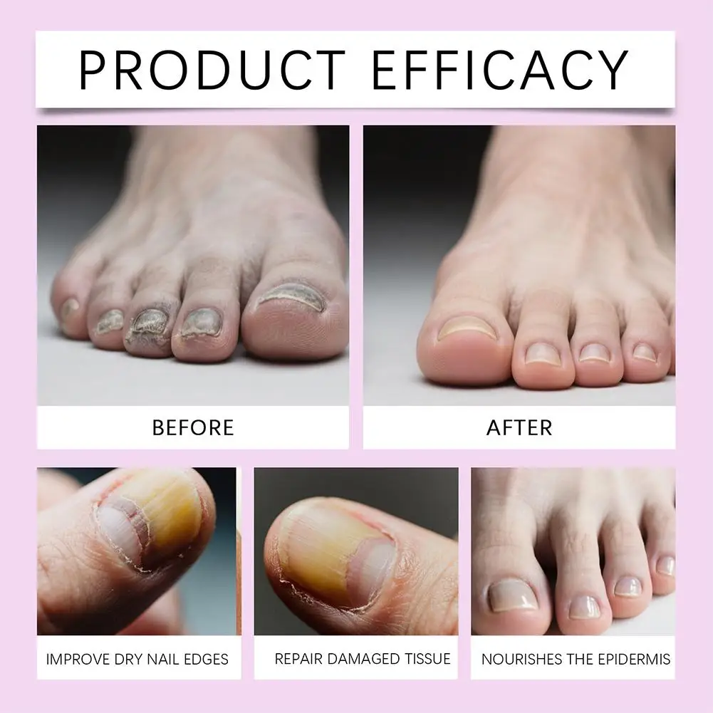 Nail Infection Repair Pen Anti Onychomycosis Paronychia Nail Fungus Removal Improve Toenail Discolored Yellowing Nail Care Pen