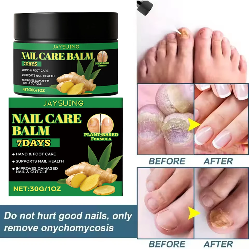 Nagel Schimmel Behandeling Crème Voet Teen Nagel Schimmel Verwijdering Essentiële Olie Anti Infectie Onychomycose Paronychia Repareren Zorg