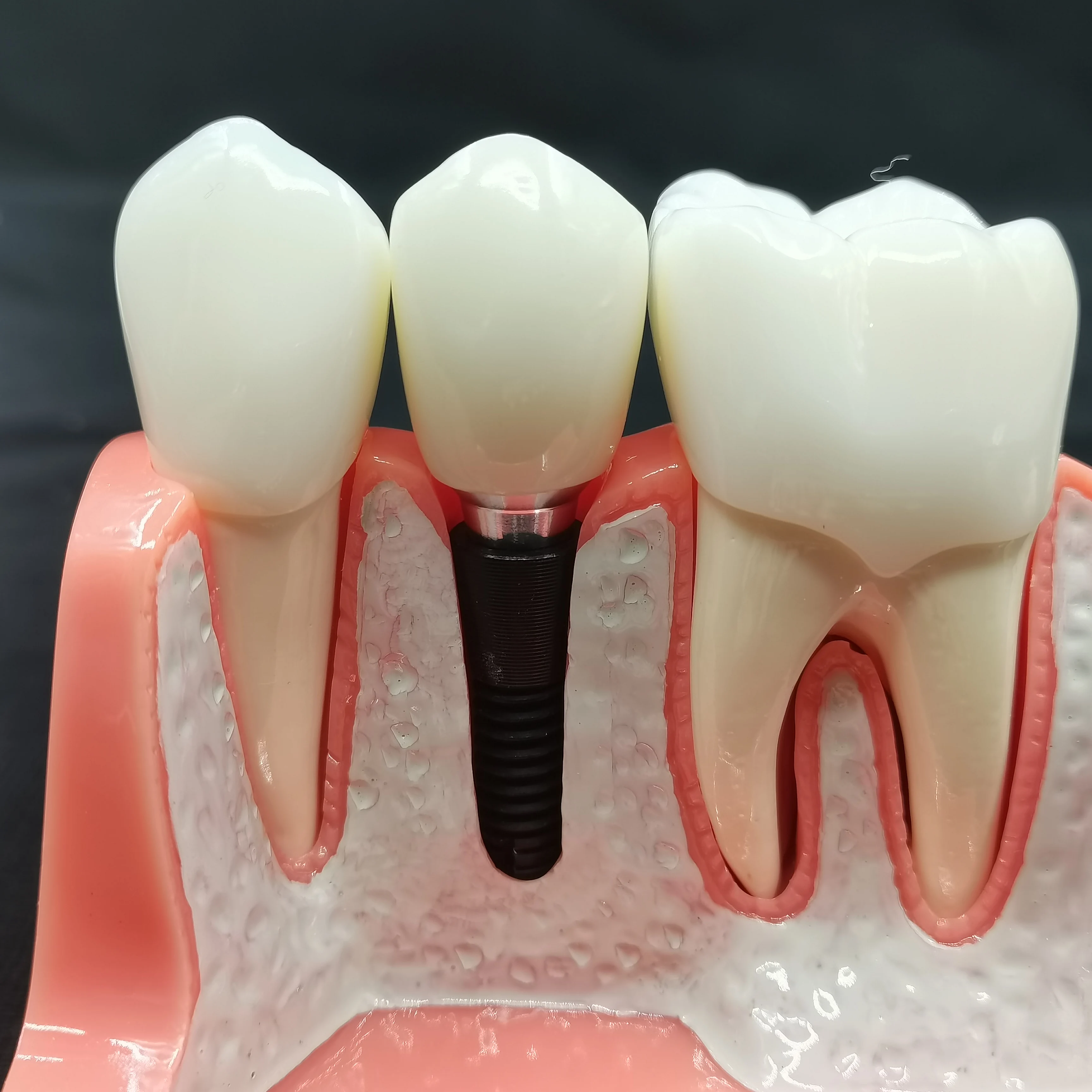 1Pcs Dental 4 Times Implant Teeth model Analysis Crown Bridge Demonstration Removable Model Dentist Teaching Training Model