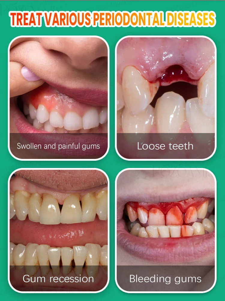 repara rápidamente la gingivitis