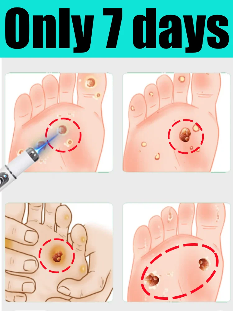 مجموعة هدايا للعناية بالثآليل ذات إصدار محدود، قل وداعاً لتكرار الثآليل، للجنسين