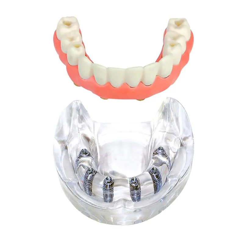 1Pcs Dental Implant Model 6 Implant Lower Tooth Implant Model Overdenture Removable Teeth Model Dentist Teaching Studying Model