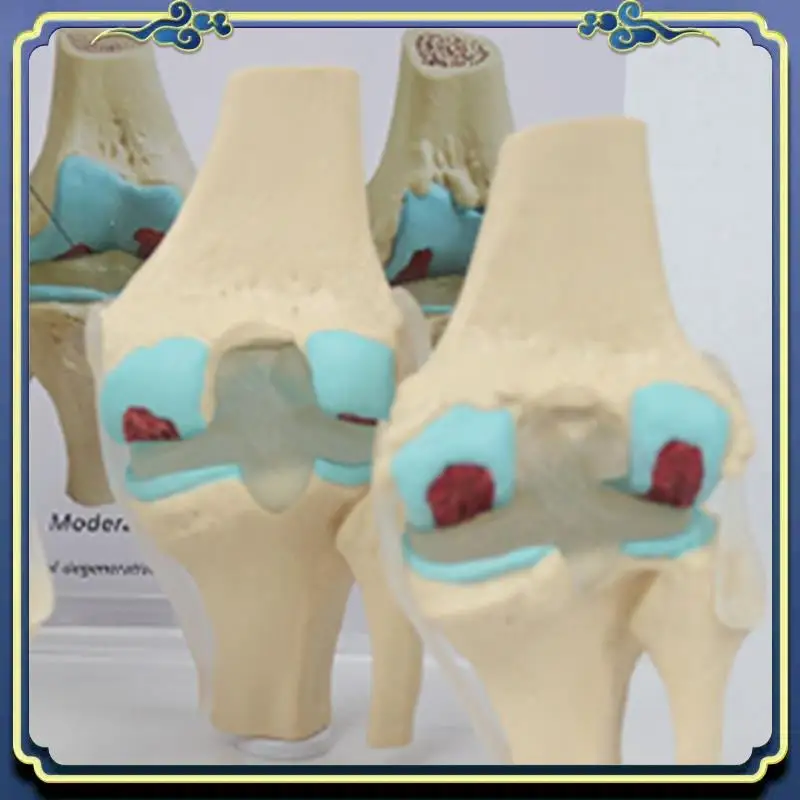 Portable Knee Kit Osteoarthritis Anatomy Model With Educational Key Card 4 Stage Knee Model Orthopedic Teaching Aids