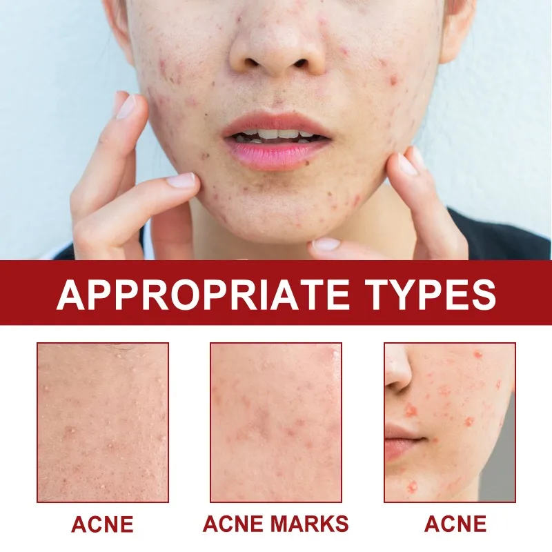 Star Acne Pimple Patch Yellow Star Shaped Absorbing Cover Patch Invisible Hydrocolloid Acne Patches for Face Acne Dots