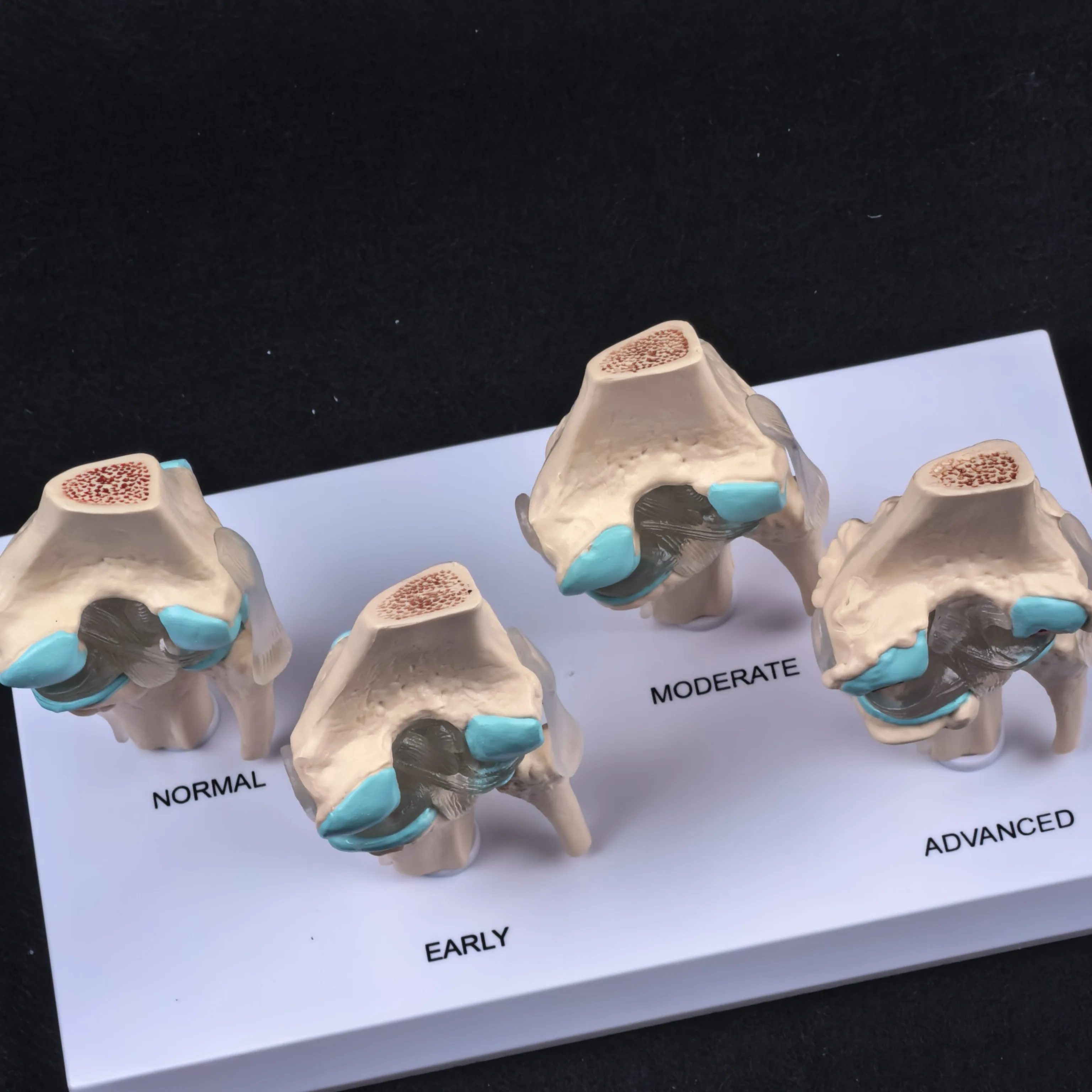 نموذج مرض مفصل الركبة التشريحي البشري المزخرف تشريح الهيكل العظمي الطبي موارد التدريس PVC #6