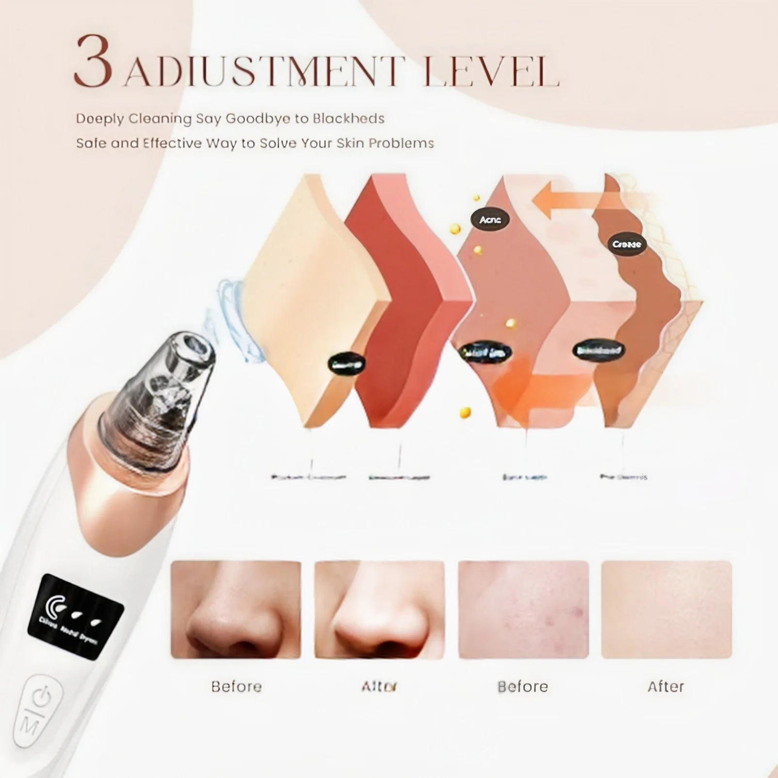 2025 mee-eter verwijderaar poriënvacuüm, gezichtsporiënreiniger - 5 zuigkracht, 5 sondes, USB oplaadbare mee-etervacuümset elektrisch A