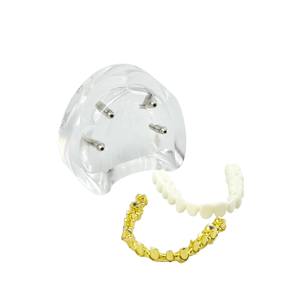 1pcs Dental Implant Overdenture Teeth Model 4 Implants Gold/Silver Bar Typodont Implant Model Dentisit Teaching Demo Model