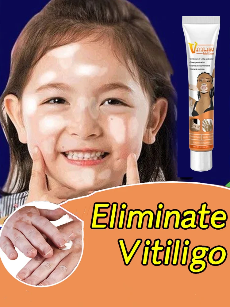 

[New] Vitiligo Cream Vitiligo Remover Tinea Versicolor Body Lotion Helps Get Rid of Sweat Spot Vitiligo, Skin Vitiligo Clear