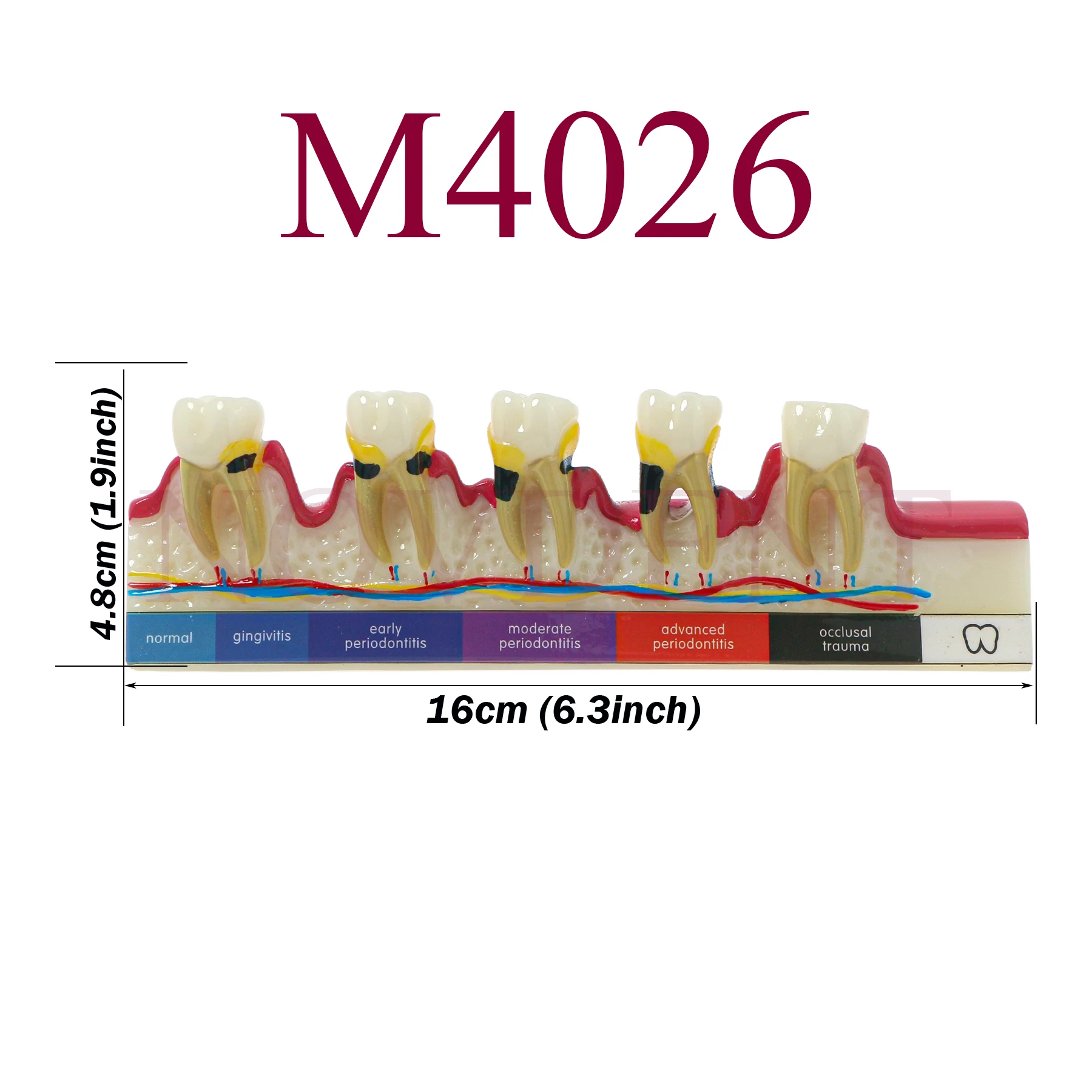 Modelo de dentes dentários m4026, modelo de doença periodontal, cárie, processo de classificação de doença periodontal, modelo de comunicação de dentista