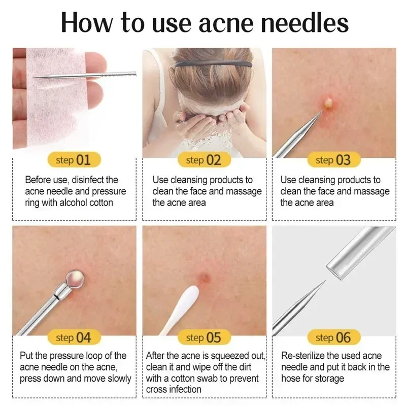 Set di strumenti per la rimozione di punti neri in acciaio inossidabile da 1/7 pezzi, clip per punti neri, pinzette, rimozione di punti neri per il viso di bellezza, strumento per ago per l'acne