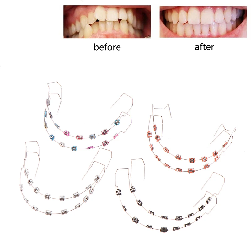 1 คู่สีสันฟันชั่วคราวตกแต่งด้วยสายโลหะวงเล็บโลหะและจัดฟัน Ligature TIES ทันตกรรมตกแต่ง