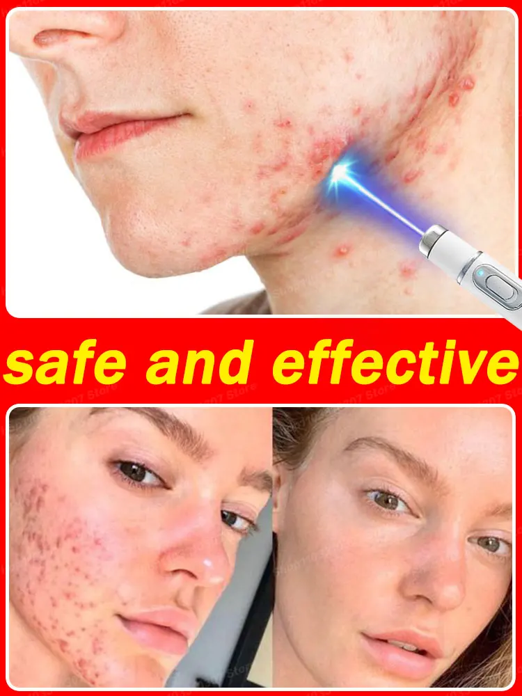 Acne Disappears Instantly