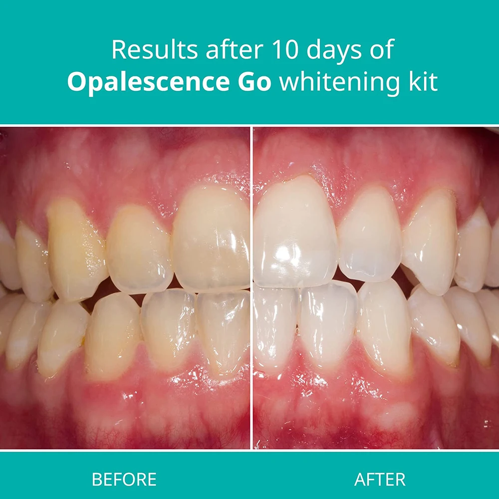 Opalescência Go Whitening Bandejas, Pré-preenchido Kit Paciente Take Home, Hortelã Sabor, americano ultravioleta