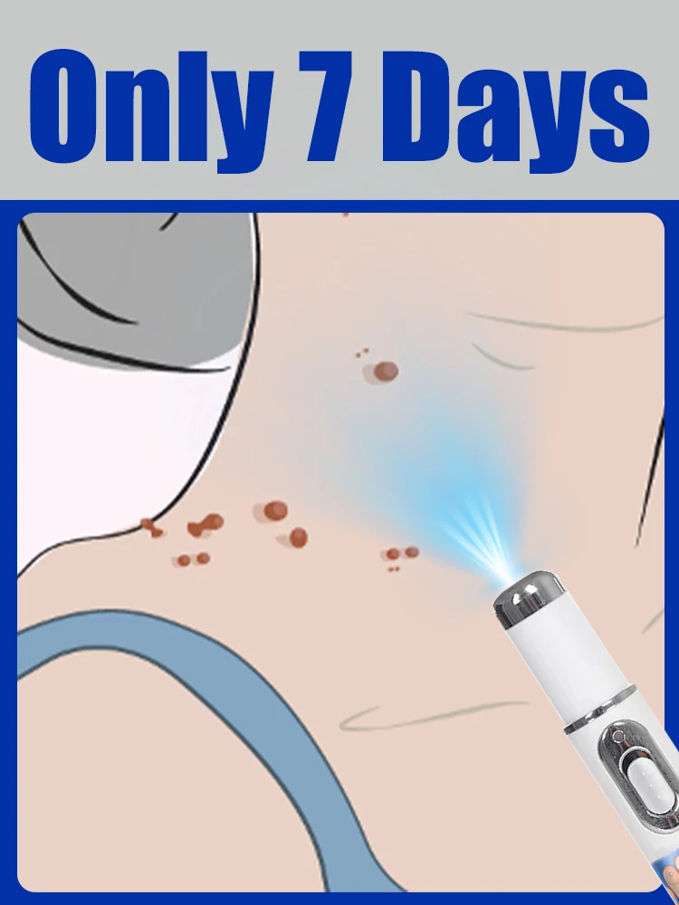 قلم الضوء الأزرق الساخن لعام 2025 يمكن أن يستخدم أداة العناية بالثآليل للاستخدام المنزلي بسهولة