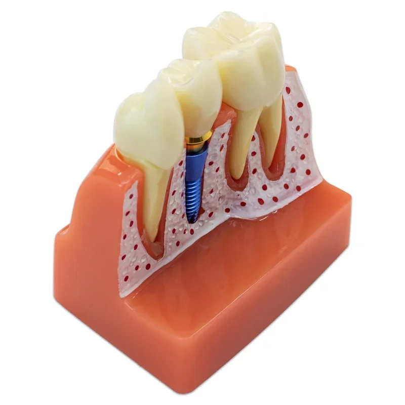 Tandheelkundig Implantaat Model Kroonbrug Model Afneembaar Tandheelkundig Model Voor Tandheelkundige Tandartsopleiding Tandheelkundige Demonstratiemodel