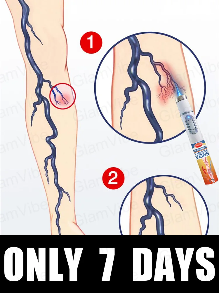 

blue light pen solve varicose veins, hot sale leg care tools