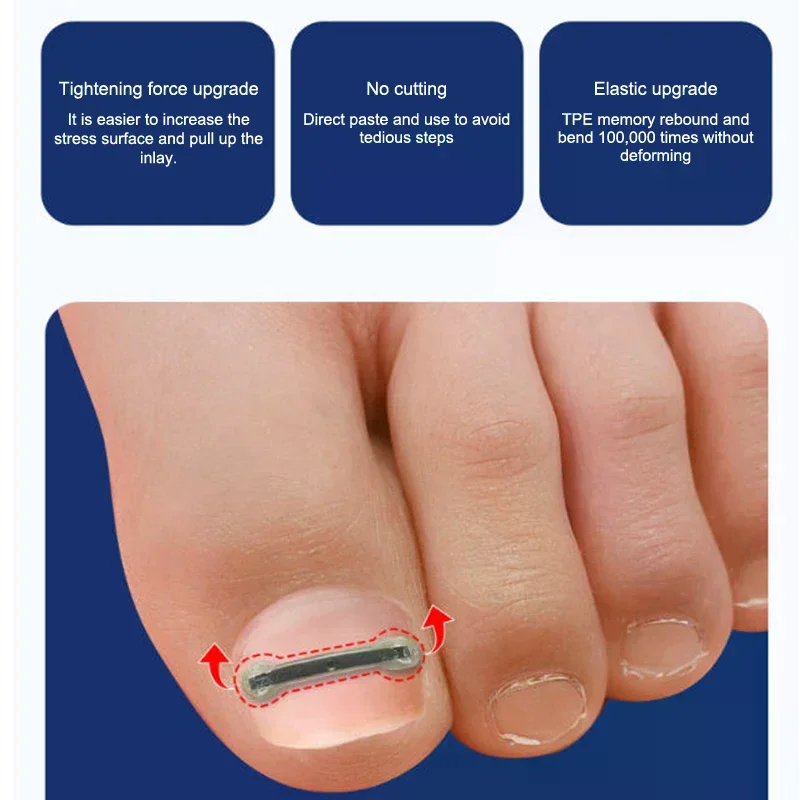 Zestaw do leczenia wrastających paznokci, 12 sztuk, z 4 różnymi rozmiarami, narzędzia do korekcji wrastających paznokci ze stopu tytanu do korekcji zakrzywionych paznokci.