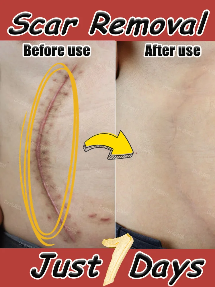 lᴀsᴇʀ-ғᴀsᴛ-sᴄᴀʀ-ʀᴇᴍᴏᴠᴀʟ-ʜᴇᴀʟᴛʜʏ-sᴄᴀʀ-ʀᴇᴍᴏᴠᴀʟ-ᴡɪᴛʜᴏᴜᴛ-sɪᴅᴇ-ᴇғғᴇᴄᴛs