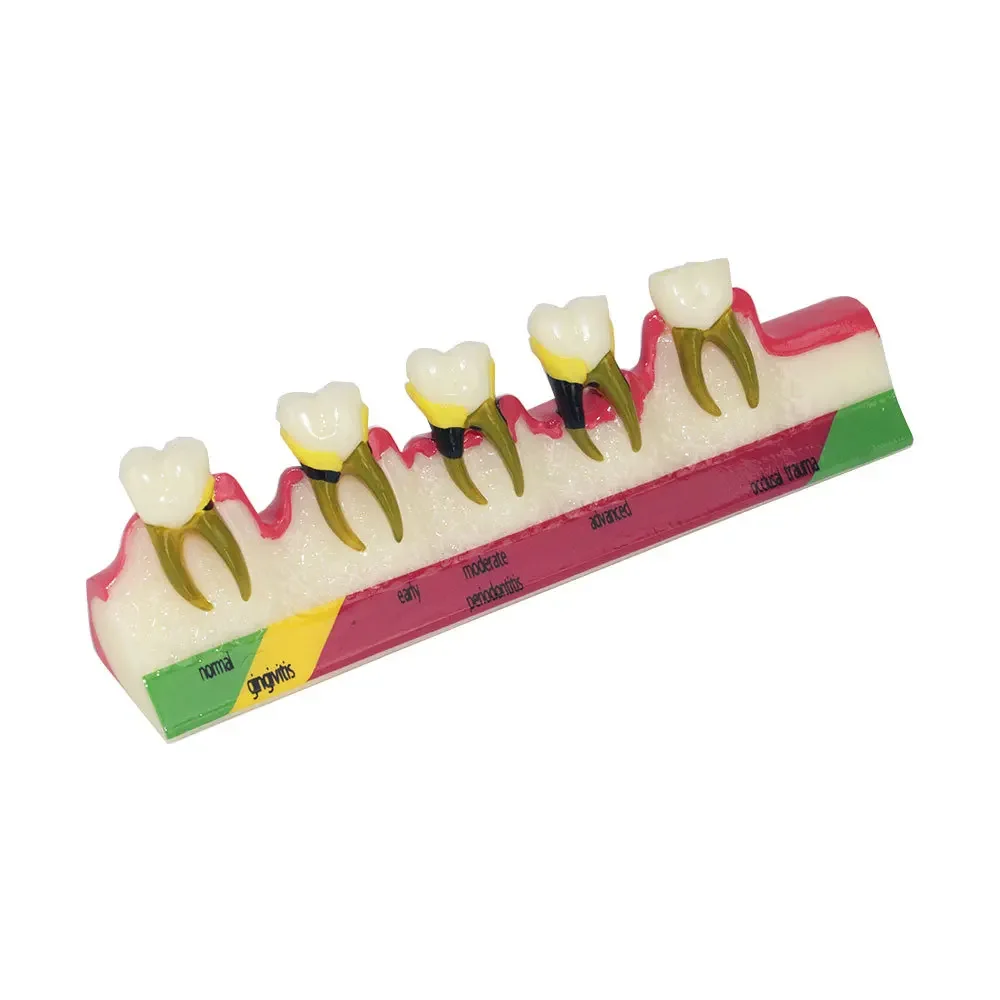 

Chronic Periodontitis And Gingivitis Degree Classification Oral Dental Model For Dental Professionals