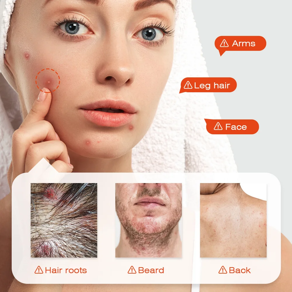 Body Acne Removal Cream Treatment Face Butt Back Acne Marks Smooth Repair Chicken Skin Cream Moisturizing Whitening Skin Care - view 3