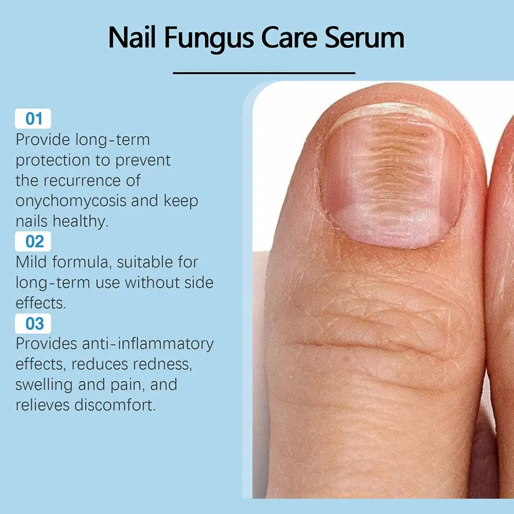 Nail Fungus Treatment Serum Foot Repair Liquid Toe Nails 30ml Fungal Anti Infection Paronychia Onychomycosis Cream Removal Z3Z3