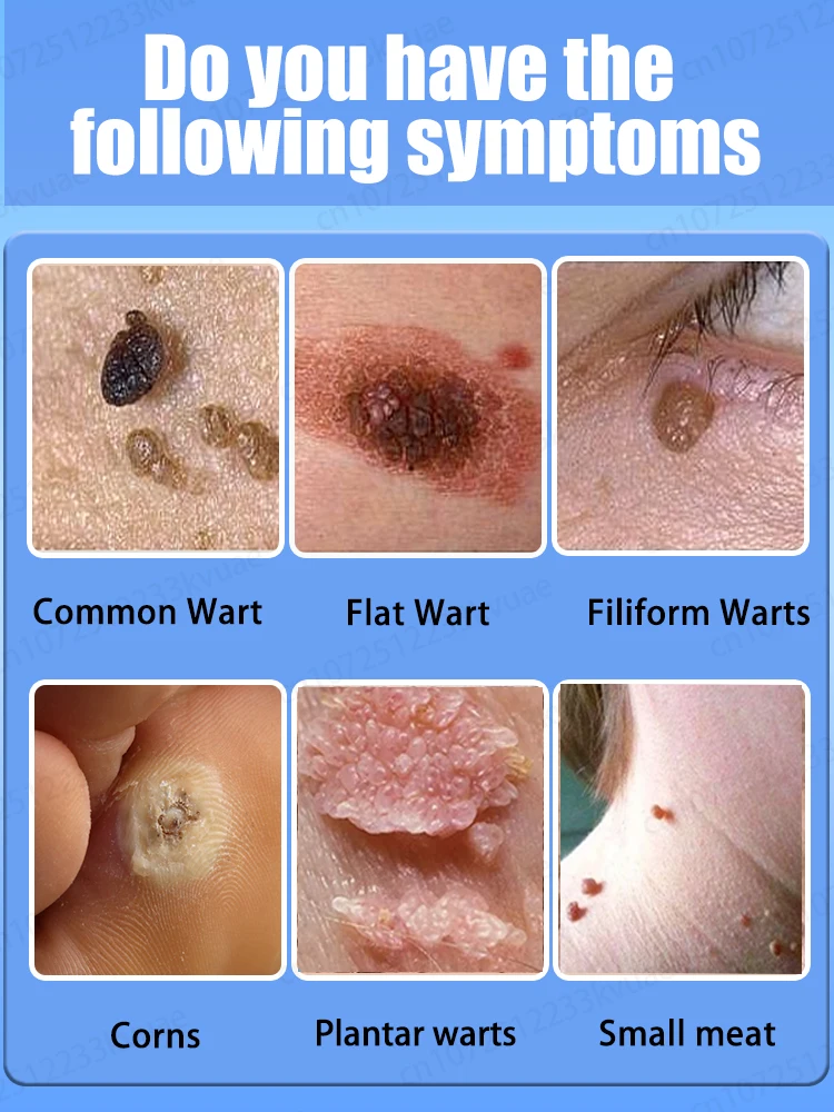 2세대 업그레이드된 사마귀 제거제 ⸴ 사마귀 치료제 ⸴ 빠르게