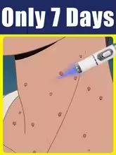 รุ่นที่ 2 ปรับปรุงใหม่ รักษาหูด กำจัดรากหูด อย่างรวดเร็ว