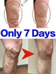 Laser Improves Varicose Veins Relieves Pain