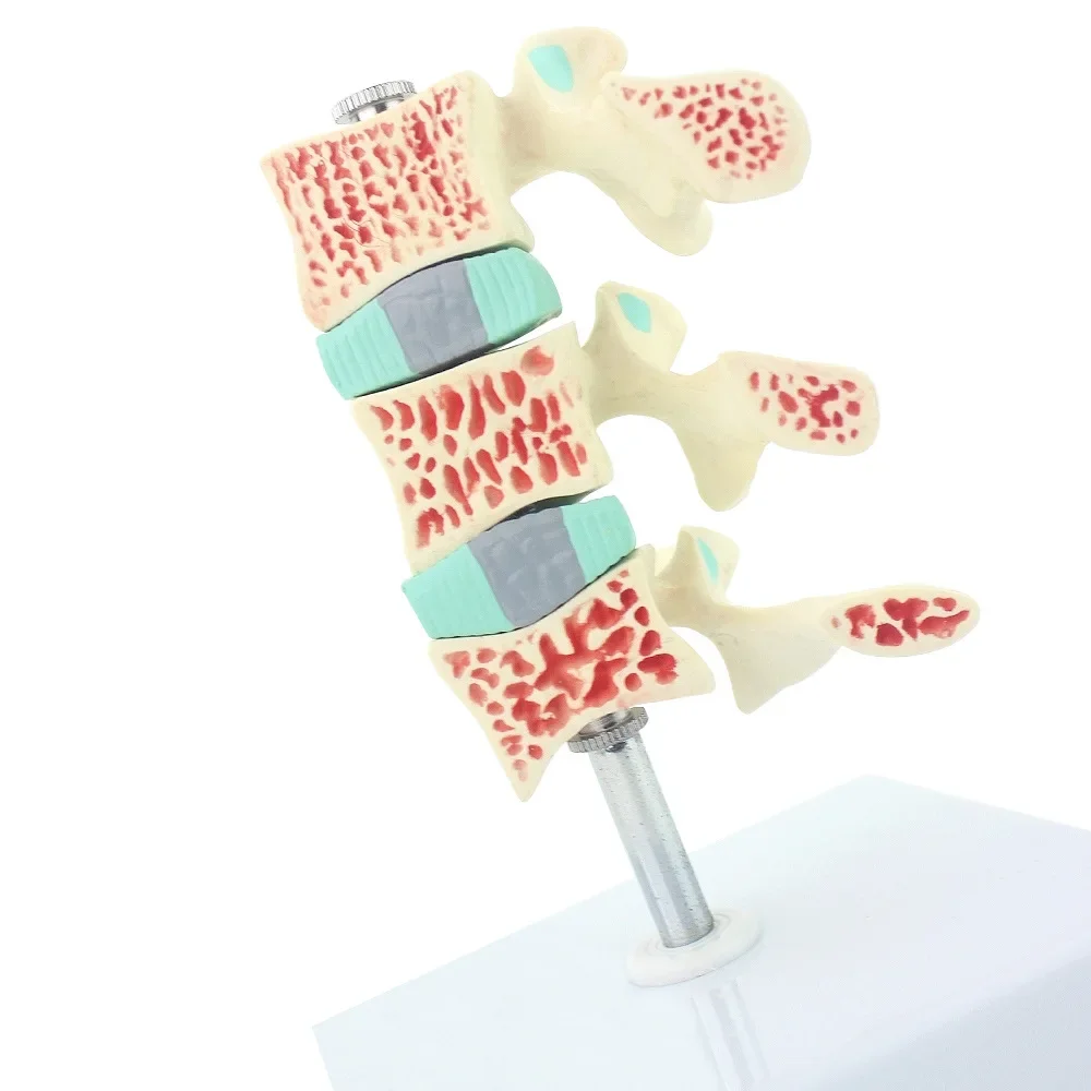 

3D модель остеопороза со спинной колонной и скелетовой системой для преподавания и исследований по медицинским наукам
