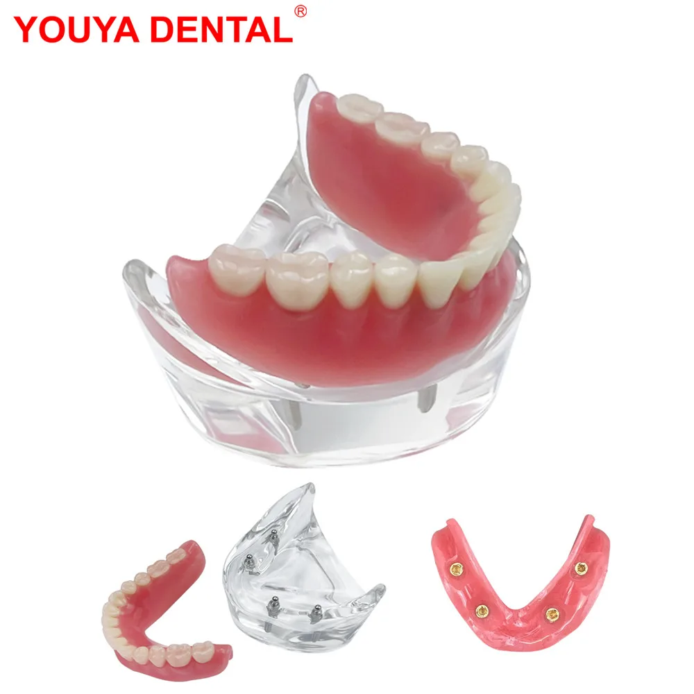 

Lower Dental Implant Model For Education Teaching Studying 4 Implants Removable Restoration Bridge Overdenture Model Transparent