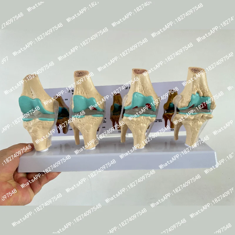 4-stage Knee Joint Model Plastic Bone Pathology Knee Anatomical Model PVC Bone Medical Skeleton Anatomy Teaching Model