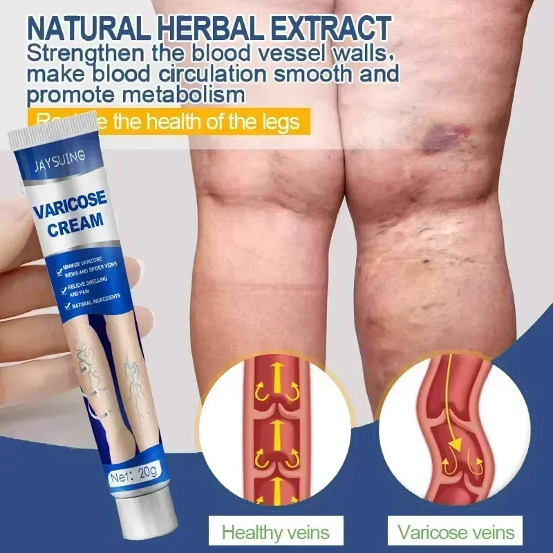 Creme de cuidados com a pele 3R para veias varicosas, elimina vasculite, flebite para aliviar a dor nas pernas de aranha, tratamento de cremes de ervas