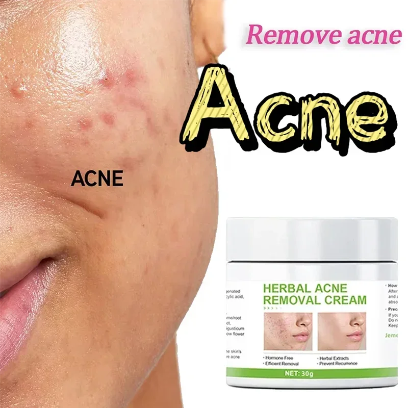 

Herbal Acne Removal Cream Whitening Moisturizing Shrink Pores Acne Treatment Gel Oil Control Pimples Scar Skin Care Face Cream