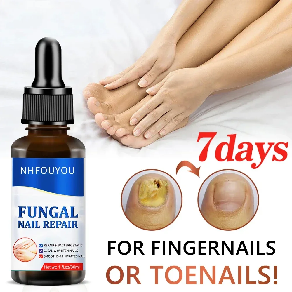 

Fungal Nail Treatment Oil Foot Repair Essence Toe Nail Fungus Removal Gel Anti Infection Cream Fungal Nail Removal 10ML