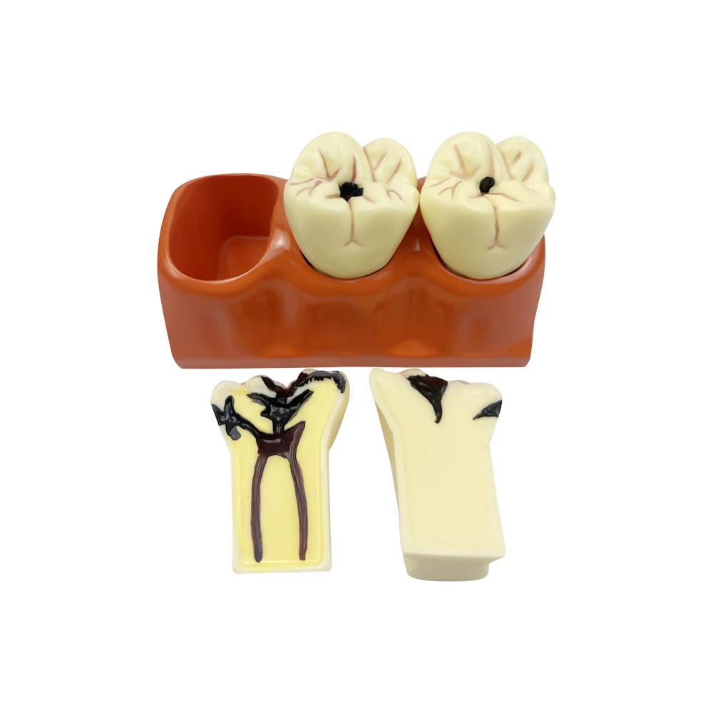 Dental Caries Model 4Times Disease Standard Teeth Model Demonstration for Teaching Research Studying Dentist Comparation