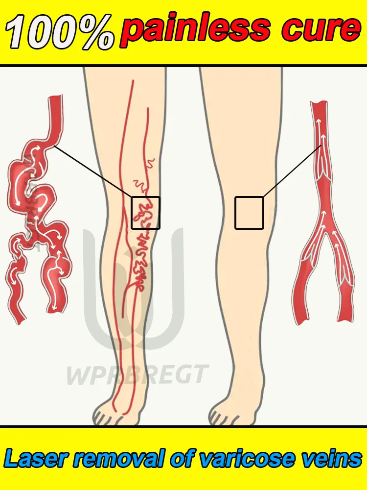 

Quickly eliminate varicose veins and promote blood circulation