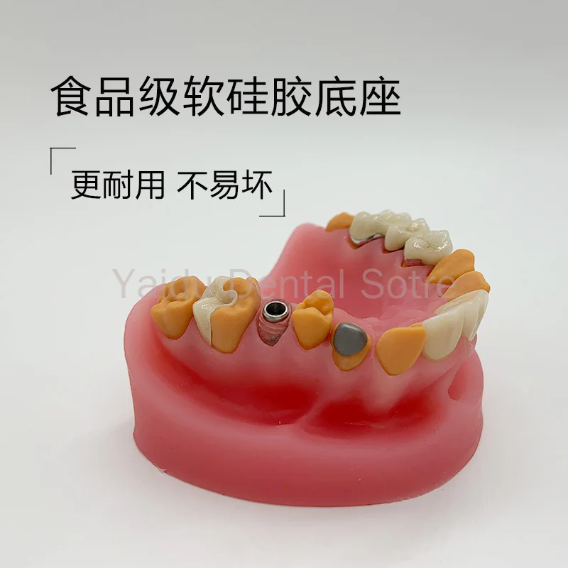 1PC Silicone Dental Restoration Mold Display Inlay Veneer Porcelain Bridge Dental Implant Abutment Model for Dental Lab Training