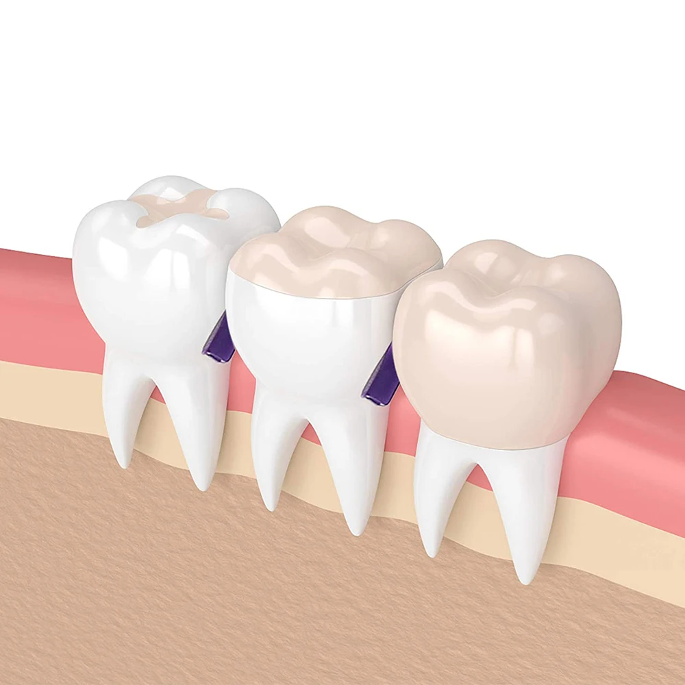 WELL CK 100 sztuk Dental jednorazowe klin z otworem 4 rozmiary materiały dentysta stomatologia Insturment narzędzia stomatologiczne zęby klin 4 kolor