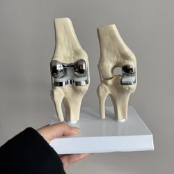 Detachable Artificial Knee Prosthesis Model Small Double Silver Knee Joint Implant Model Set