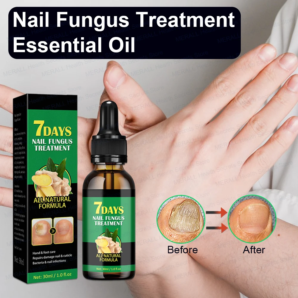 Nail Fungal Treatment Device 7 Days Repair Oil Foot Toe Essence Anti Infection Paronychia Ginger Onychomycosis Gel Care Products