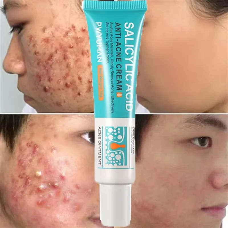 

Salicylic Acid Acne Treatment Face Cream Repair Pimple Spots Deep Cleaning Pore Anti-acne Scar Oil Control Moisturizer Skin Care