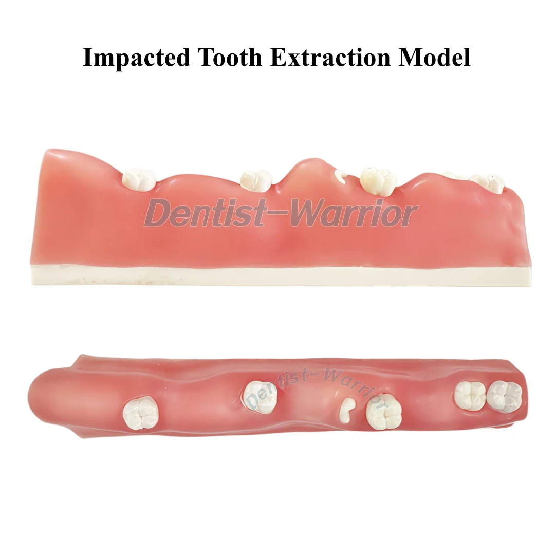 Unerupted Impacted Tooth Extraction Model Dental Practice Wisdom Training Model Practice