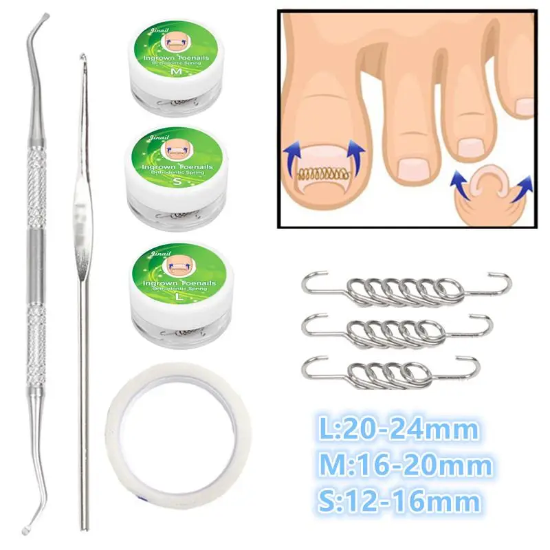 Ferramentas corretoras de unhas encravadas, pedicure, recuperação, tratamento de unhas encravadas, profissional, correção de unhas encravadas, ferramenta de cuidados com os pés