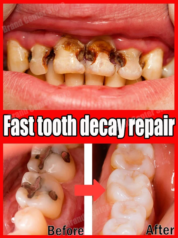 repair Tooth decay all cavities