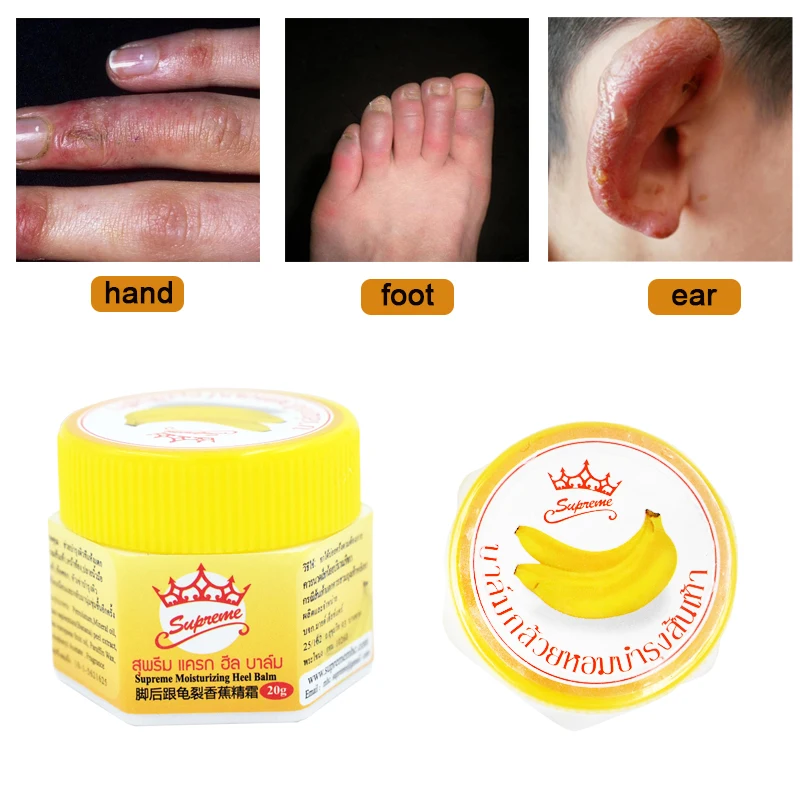 Snake Oil Chilblain Cream Hand Foot Crack Frostbite Dry Crack Skin Creams Heel Chapped Peeling Repair Ointment