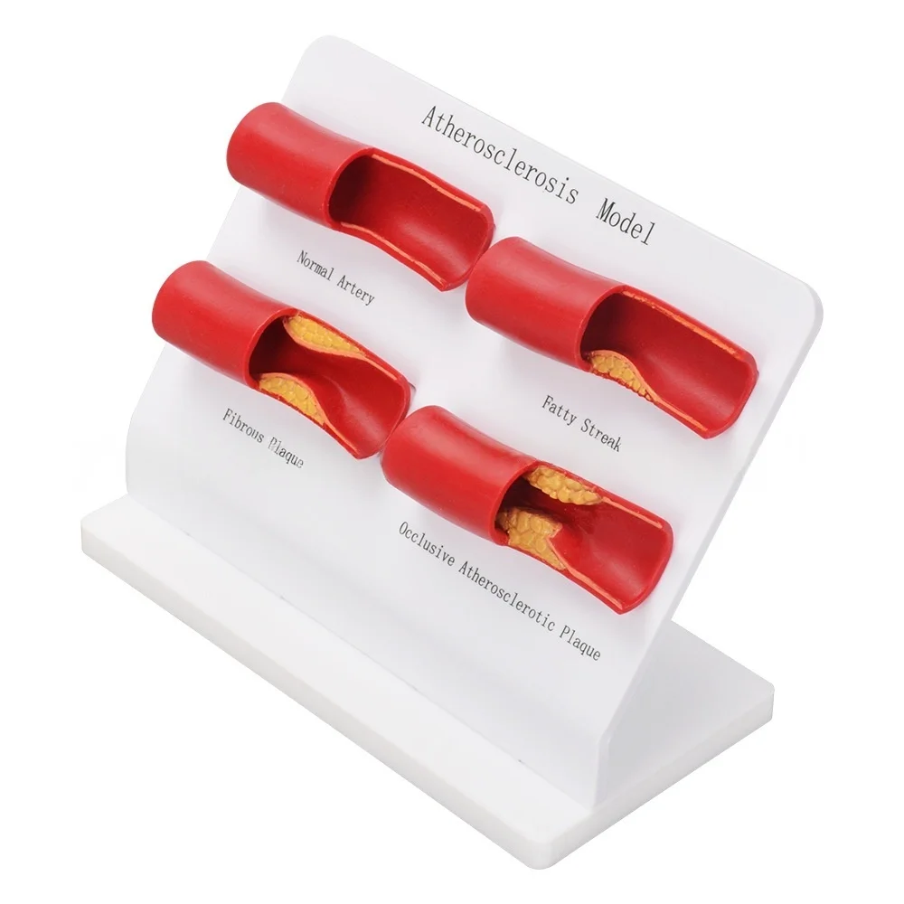 Teaching Demonstration Model, Arterial Atherosclerosis Model, Vascular Model, Vascular Sclerosis Comparison Model