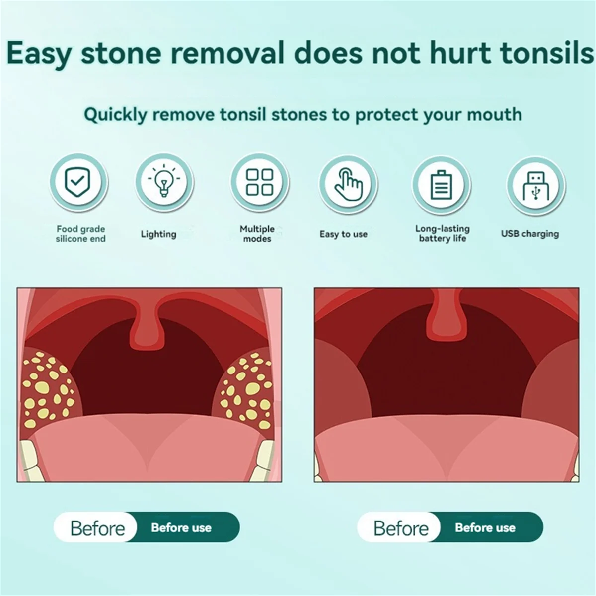 مجموعة إزالة حجر اللوزات الإلكترونية BVBV، مكنسة إزالة حجر اللوزات، منظف الفم الأوتوماتيكي للعناية بالفم، منظف اللوزات